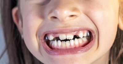儿童反颌什么时候矫正比较好？儿童牙齿矫正有哪些注意事项？