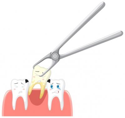 为啥医生说窝沟黑线不用补牙？牙齿坏到什么程度需要补牙？
