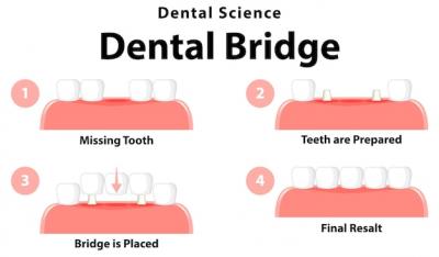 活动义齿精密附着体/基托活动假牙/吸附性哪种好？