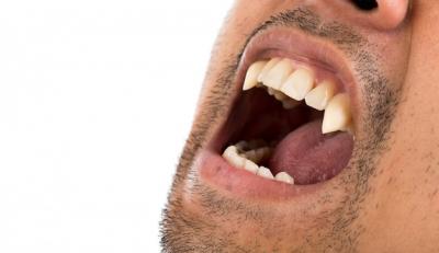 40岁拔牙多久可以种植牙，拔牙9个月种植算晚吗？