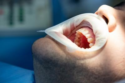 一般什么情况下牙齿需要根管，牙齿根管治疗需要多久，费用如何算？