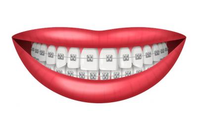 金属矫正牙齿期间可以洗牙齿吗，洗牙齿好吗，洗牙齿一次多少钱