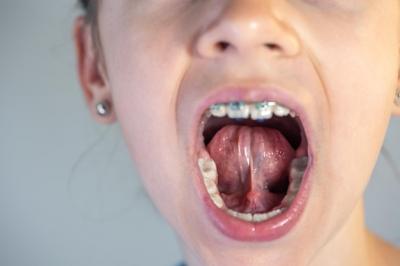 儿童牙齿反颌什么时候矫正好？儿童矫正牙齿方法有哪些？