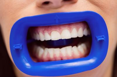 家用美牙仪能否真正美白牙齿？使用对牙齿有无损害？
