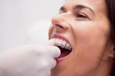 牙齿矫正器选择，时代天使牙齿矫正方案的来源及其矫正技术的优缺点详解
