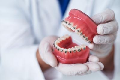 牙齿矫正牙套的类型及其价格详细对比。