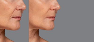 深覆合矫正脸型变化图，矫正治疗对面部的影响