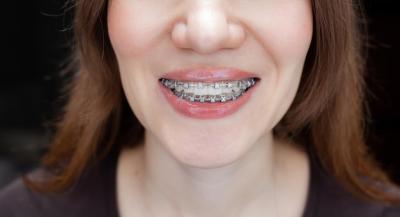 牙齿矫正打骨钉的作用是什么？牙齿拥挤要拔牙矫正吗？