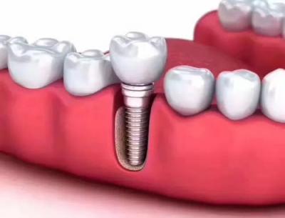 种植牙能维持多少年？种植牙能媲美天然牙的原因是什么？