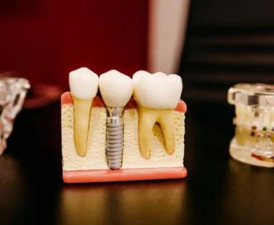  种植牙需要注意什么？怎么判断一个种植牙医生是否专业？