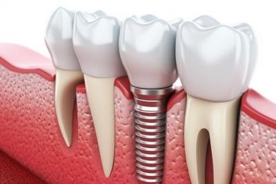 种植牙的治疗原则是什么？种植牙松动该怎么办？
