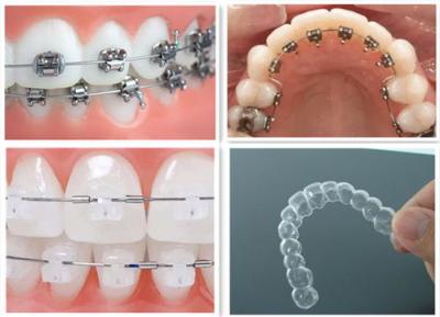  成人牙齿地包天可以矫正吗？牙齿矫正陶瓷和钢丝哪个好？
