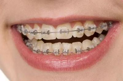 牙齿轻微外突需要矫正吗？怎么判断牙齿矫正诊所靠不靠谱？