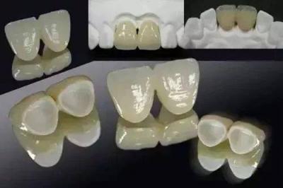 什么情况下适合做烤瓷牙？烤瓷牙会造成牙龈萎缩吗？
