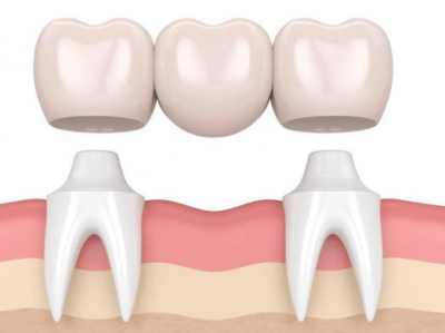  牙科小知识：烤瓷牙使用过程中需要注意哪些注意事项？