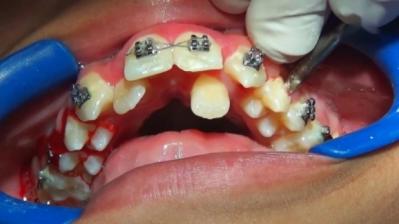 死髓牙是怎么形成的？死髓牙能做牙齿矫正吗？