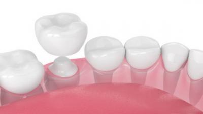 为什么烤瓷牙要防假牙过敏？烤瓷牙对牙齿功能会有影响吗？