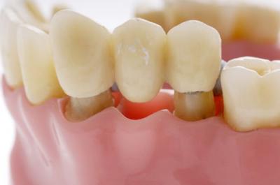 牙科小知识：如何避免烤瓷牙修复后出现牙龈黑线？