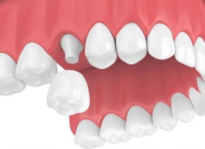 牙科小知识：除了种植牙，还有哪些方法可以修复缺失的牙齿？