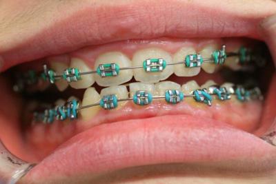 怎么判断正畸医生是否专业？牙齿矫正属于整容吗？