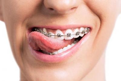 牙齿矫正需要多久？矫正牙齿时间长短取决于什么？