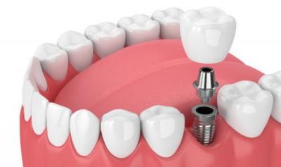 种植牙有什么风险？如何护理种植牙才可以更耐用？