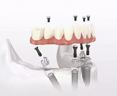 百康特种植牙是纯钛的吗？有什么优势？是纯钛的吗？有什么优势？