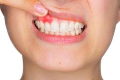 牙科小知识：龋齿烂到神经不治疗会有什么后果？