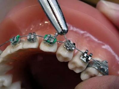 正畸科普：在使用钢丝进行牙齿矫正时，如何避免钢丝对口腔黏膜的损伤？