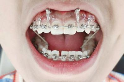 牙齿矫正出现牙套脸的概率大吗？出现牙套脸了要怎么做？