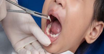 儿童拔牙后多久能正常进食？儿童拔牙后有哪些注意事项？