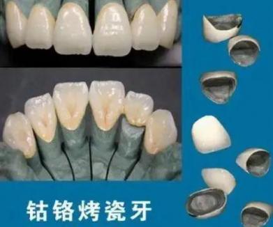 钴铬烤瓷牙有哪些优缺点？钴铬烤瓷牙的使用寿命是多久？
