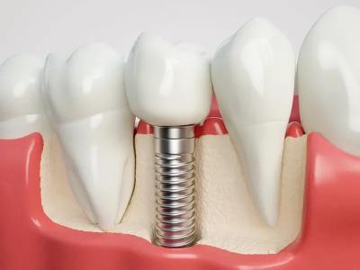 种植牙小知识：种植牙医生的技术水平和哪些因素有关？
