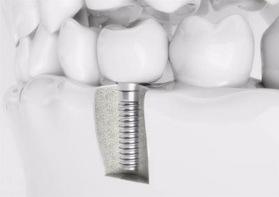 种植牙小知识：如何选择正规的牙科医院和有经验的医生进行种植牙手术？