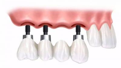 种植牙晃动的原因是什么？种植牙晃动的修复方法有哪些？