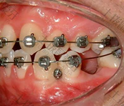 如何判断智齿对矫正牙齿是否有影响？矫正牙齿时的酸痛感会持续多久？