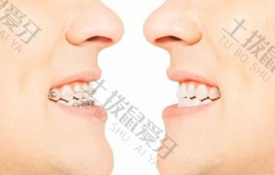 正畸科普：有哪些方法可以帮助提高矫正牙齿的成功率？