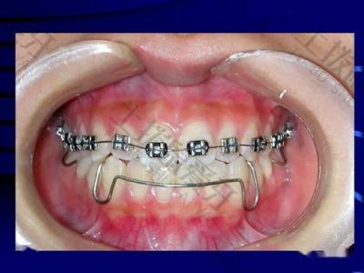 正畸科普：有哪些方法可以预防智齿对矫正牙齿的影响？