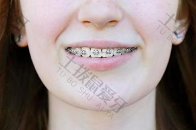 智齿会影响矫正牙齿吗？牙齿矫正酸痛怎么缓解？