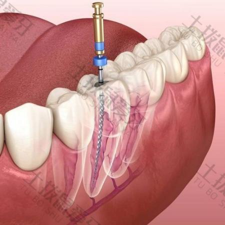 牙齿根管治疗是怎么回事？牙齿松动要怎么治疗？