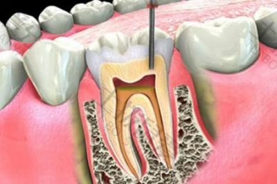 牙科小知识：哪些情况下根管治疗后的牙齿需要重新治疗？