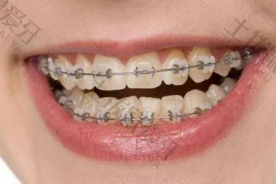 遗传性的牙齿畸形能矫正吗？矫正牙齿会变牙套脸吗？