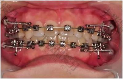 正畸科普：关于矫正牙齿，有哪些必须要知道的问题？