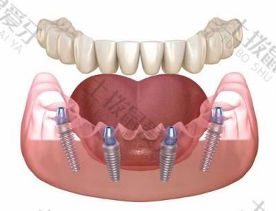 种牙小知识：种植牙的成功率和患者的口腔健康状况有关系吗？