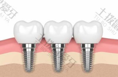 种植牙失败后再次需要注意什么？种植牙术后如何维护和保养？