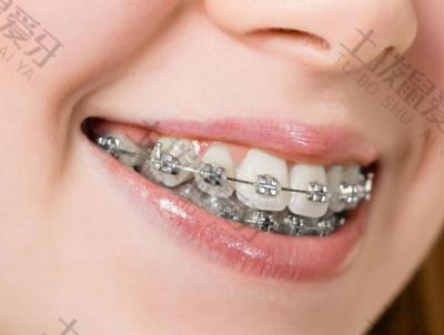 牙齿矫正要注意些什么？二次矫正牙齿的危害有哪些？
