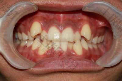 矫正牙齿可以改善牙周炎吗？牙齿扭转如何矫正？