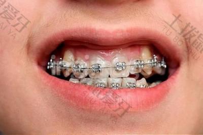 牙齿矫正失败后应该如何处理？如何预防矫正牙齿后出现的牙龈问题？