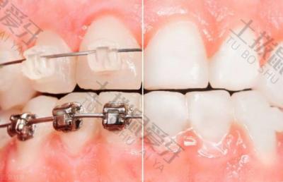 正畸科普：在牙齿矫正失败后有哪些方法可以修复？
