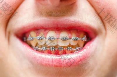 重新矫正前需要对牙周进行哪些检查？牙周健康的标准是什么？